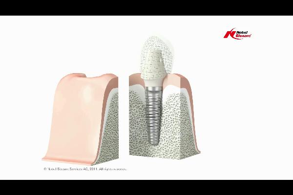 Single-Tooth-Solution_no-watermark_e_tcm261-41508